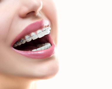 Close up the open mouth with Ceramic and Metal Braces on beautiful Teeth