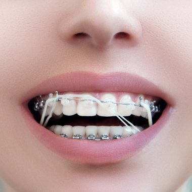 Closeup Dental Brackets with Rubber Elastic Band. Open Female Mouth with Self-ligating Braces. Orthodontic Treatment.