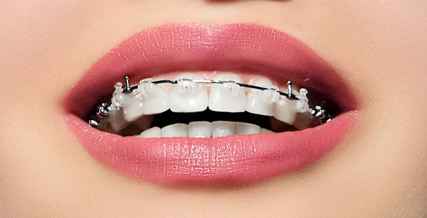 Close up open mouth with Ceramic and Metal Braces on beautiful Teeth. Broad Smile with Self-ligating Brackets. Orthodontic Treatment.