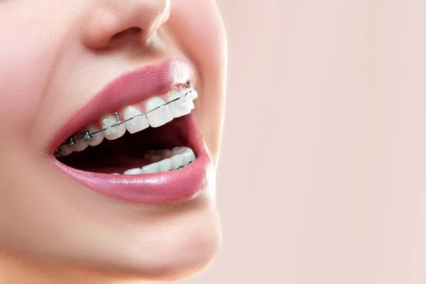 Zavřít Otevřenou Tlamu Keramické Kovové Rovnátka Krásné Zuby — Stock fotografie