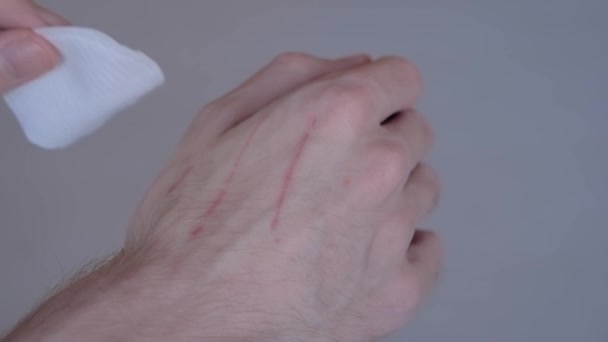 Kedi tırmalamalarını pamuk ped ve hidrojen peroksit ile tedavi etmeye çalışan adam: yakın çekim — Stok video