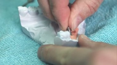 Diş implantlarının kurulum süreci gösteriliyor