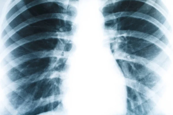 Рентген легких человека крупным планом — стоковое фото