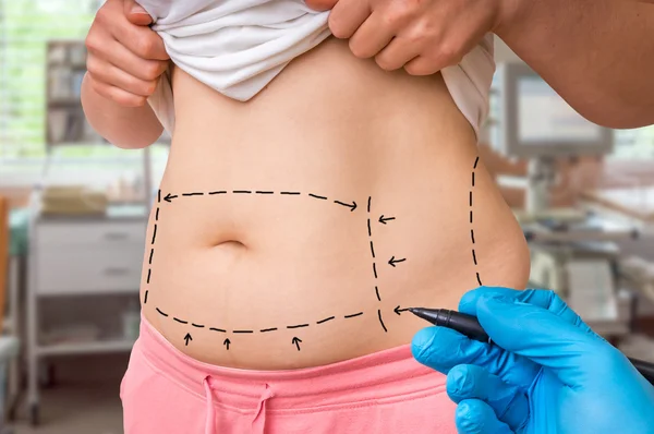 Plastic surgery doctor draw lines with marker on patient belly — Stock Photo, Image