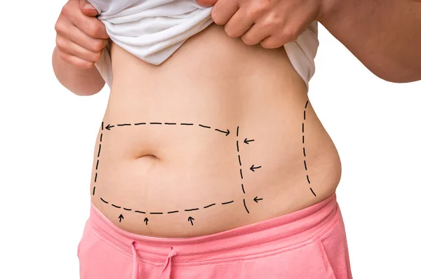 Plastic surgery doctor draw lines with marker on patient belly — Stock Photo, Image