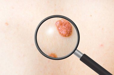 Dermatolog Doktor hastanın bir doğum lekesi inceliyor