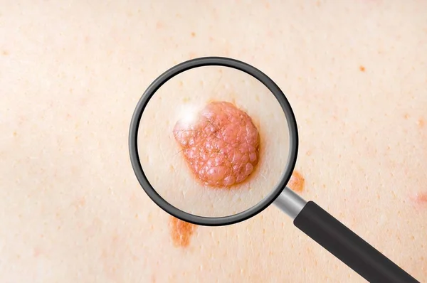 Dermatologist doctor examines a birthmark of patient — Stock Photo, Image