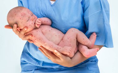 Newborn baby with chickenpox clipart