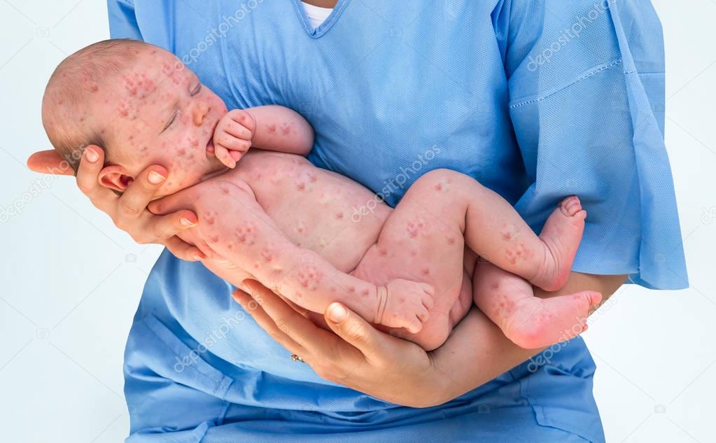 Newborn baby with chickenpox