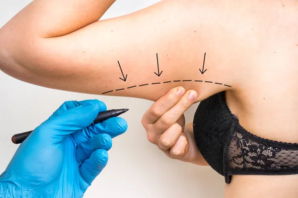 Plastic surgery doctor draw line on patient arm — Stock Photo, Image
