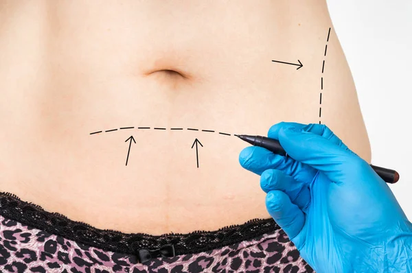 Plastische Chirurgie Arzt zeichnen Linien auf Patientenbauch — Stockfoto