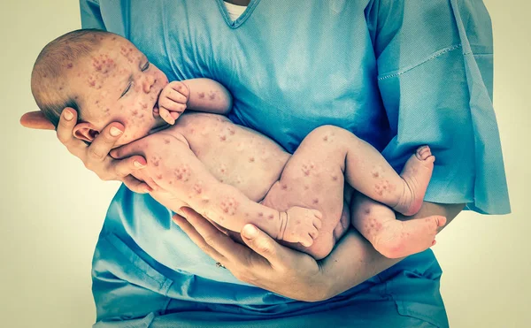 Newborn baby with chickenpox - retro style — Stock Photo, Image