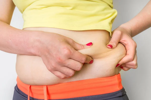 Übergewichtige Frau mit Fett an den Hüften - Adipositas-Konzept — Stockfoto