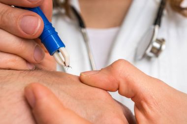 Doktor bir kene cımbız ile hasta elden çıkarma.