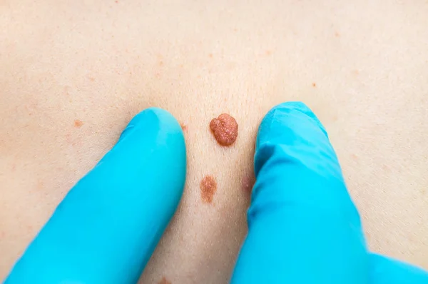 Woman with birthmark on her back, skin tags removal — Stock Photo, Image