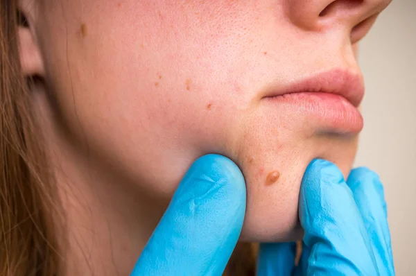 Woman with birthmark on her face, skin tags removal — Stock Photo, Image