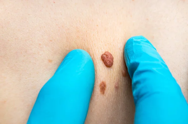 Woman with birthmark on her back, skin tags removal — Stock Photo, Image