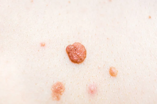 Woman with birthmark on her back, skin tags removal — Stock Photo, Image