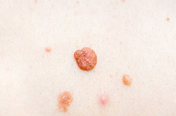 Woman with birthmark on her back, skin tags removal