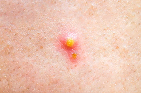 Sivilce veya yüzünde sivilce yakın çekim fotoğraf