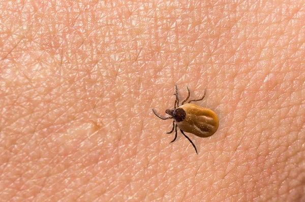 Tick filled with blood crawling on human body skin — Stock Photo, Image