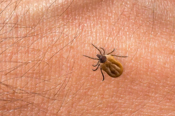 Garrapata llena de sangre arrastrándose sobre la piel del cuerpo humano —  Fotos de Stock