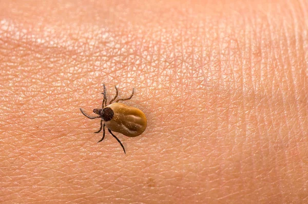 Garrapata llena de sangre arrastrándose sobre la piel del cuerpo humano — Foto de Stock