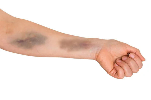 Großer Bluterguss am menschlichen Arm — Stockfoto
