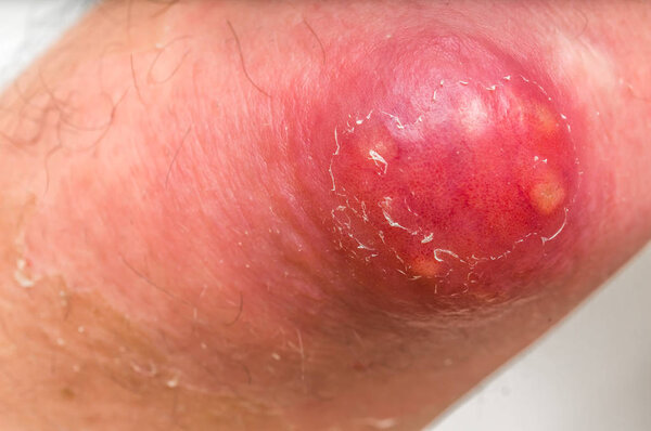 Detailed view of elbow with carbuncle or furuncle