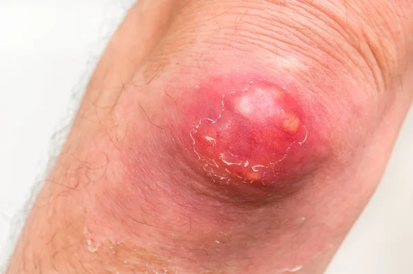 Dirsek Çiban veya Çiban ile ayrıntılı bir görünümünü