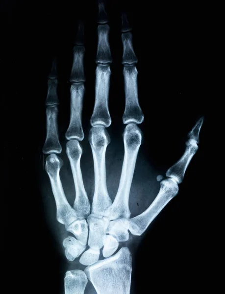 Zdjęcie rentgenowskie ludzkiej ręki — Zdjęcie stockowe
