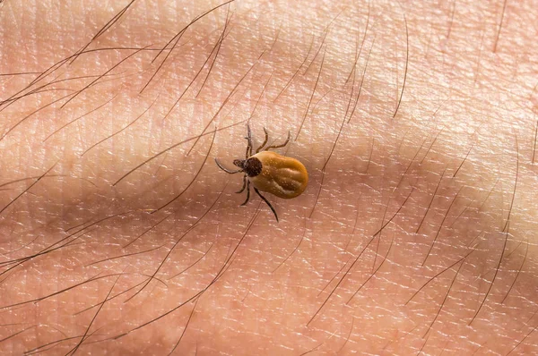 Tick se arrastra sobre la piel del cuerpo humano — Foto de Stock