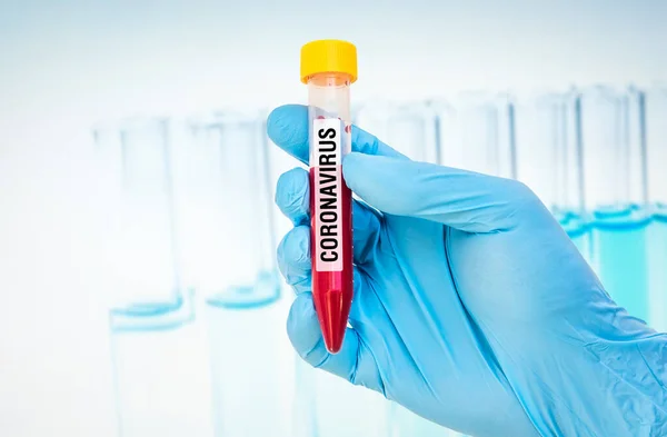 Δοκιμαστικός σωλήνας με θετική εξέταση αίματος στον ιό Coronavirus — Φωτογραφία Αρχείου