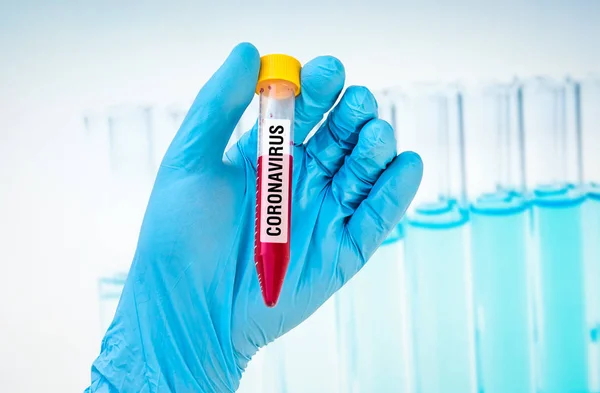 Test-tube with positive blood test on CORONAVIRUS