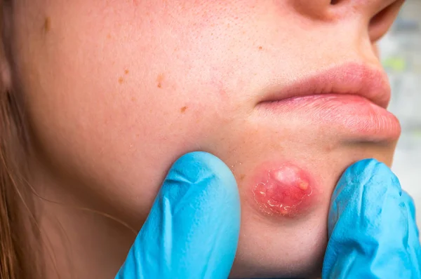 Detailed view of face of woman with carbuncle or furuncle — Stock Photo, Image