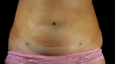 laparoskopi sonra izleri ile kadın göbek