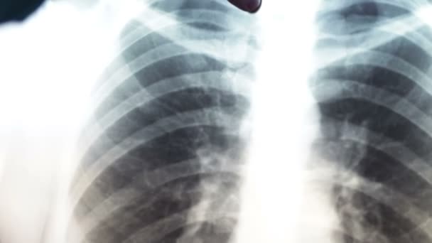 Ακτινογραφία των πνευμόνων του ανθρώπου. Διαγνωστικός έλεγχος για την πρόληψη του καρκίνου του πνεύμονα. — Αρχείο Βίντεο