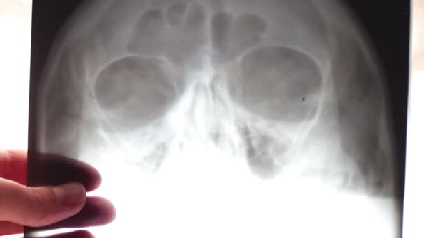 Le docteur regarde la radiographie du crâne humain et des sinus maxillaires. — Video