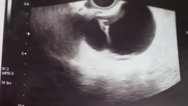 Tıbbi ultrason fotoğraf, sol yumurtalık kisti, hastanede acil cerrahi patoloji ile kadın yumurtalık yakın çekim — Stok video