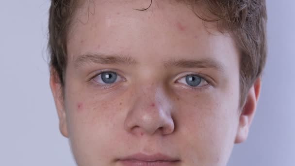A cute teen boy with blond hair and blue eyes with problem skin and teenage acne is looking at the camera on a white background. Dermatological problems in a teenager. Young guy in a transitional age — Stock Video