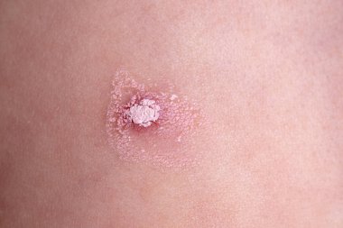 Suçiçeği sivilcesi