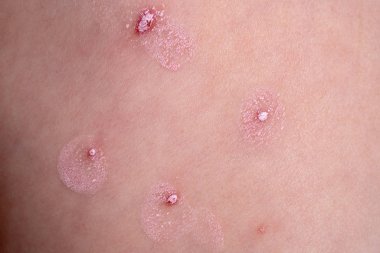 Su çiçeği sivilceleri krem sürülmüş.