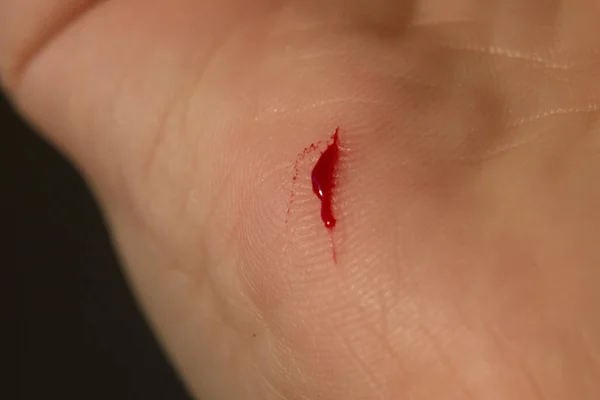 Djupt huggen orsakas av kniv i hand palm — Stockfoto