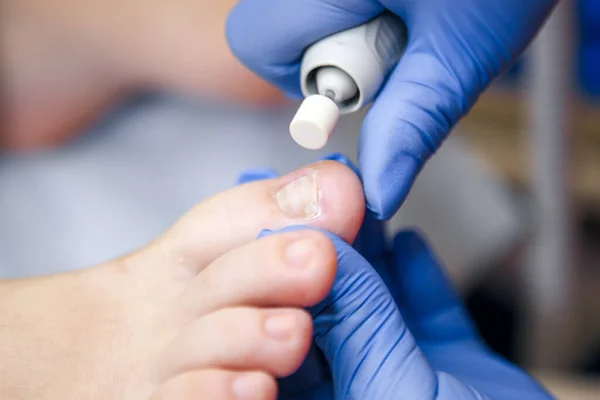Podology treatment. Podiatrist treating toenail fungus. Doctor removes calluses, corns and treats ingrown nail. Hardware manicure. Health, body care concept. Selective focus.