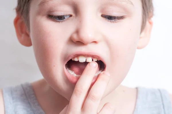 Blue-eyed blond boy laughs and shows the first tooth. children\'s teeth, loss and fingers pointed at the incisor teeth, children\'s mouths of child close up, incisor milk tooth missing of kid