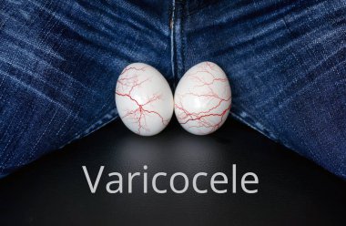 Varikosel - erkek hastalık erkeklerde kısırlık önde gelen
