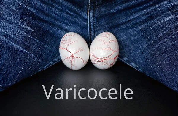 Varicocele - male disease leading to infertility in men — Stock Image Varicocele - male disease leading to infertility in men Stock Image