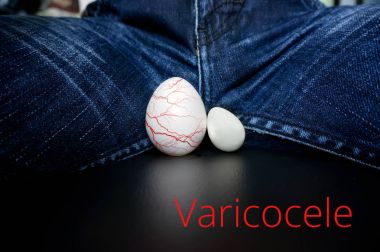 Varikosel - erkek hastalık erkeklerde kısırlık önde gelen