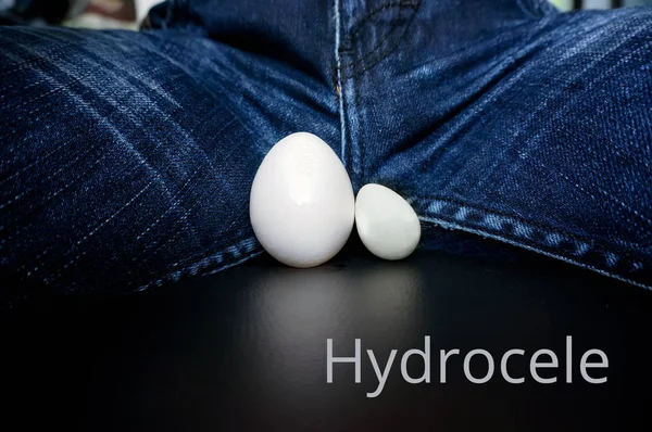 El concepto de la enfermedad hidrocele — Foto de Stock