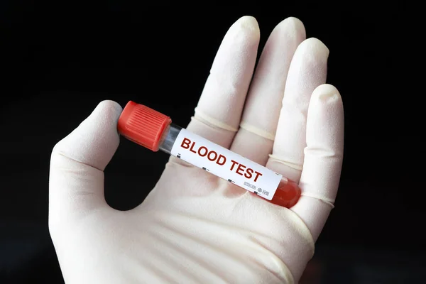 Доктор Тримає Пляшку Зразка Крові Чорному Тлі Перевірка Цукру Крові — стокове фото